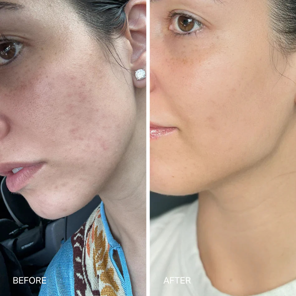 THE LASER SERUM TRIPLE ACID CONCENTRATE